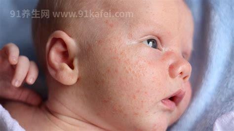 儿童猩红热皮疹图片，发热全身长鸡皮样的鲜红疹要注意(7天左右消退)