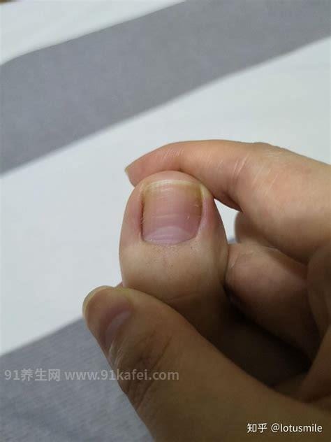 灰指甲初期症状图片及治疗方法，有两大症状需及时治疗(慎入)