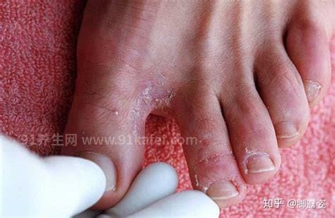 脚气图片水泡型初期症状，有水疱清亮疱液不要挑破(夏季多发)