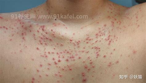 毛囊炎图片和初期症状，瘙痒疼痛的红色丘疹会发展成脓包