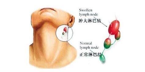 腋下淋巴癌早期症状图片，可移动的无