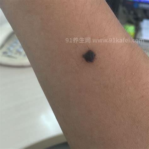 黑色素瘤图片，皮肤痣的颜色/大小/表