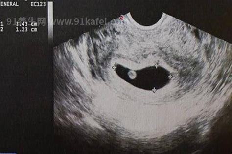 孕囊形状看男女(超准)，看6-7周的3个