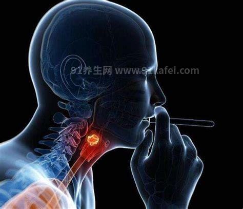 警惕喉癌的5大早期症状图片，中了两点的赶紧去医院做检查