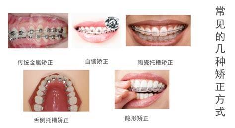 常见的牙齿整形方法 牙齿整形的注
