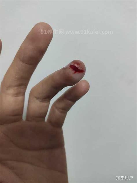 手被纸割伤后为什么会特别痛 手指