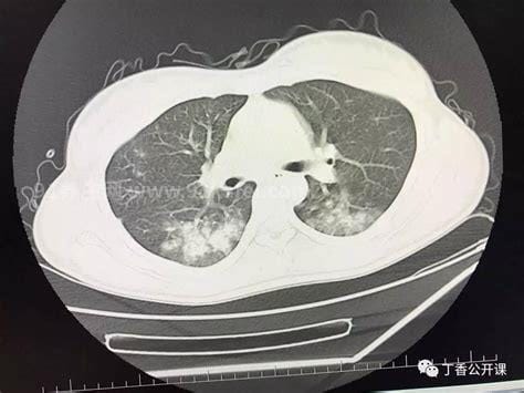 新冠肺部CT检查多少钱一次多久出结