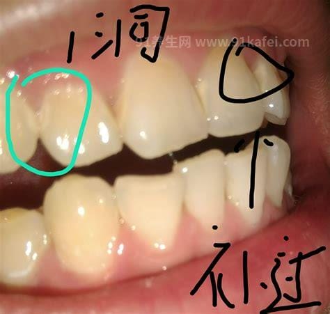 牙釉质脱落早期图片及症状，为牙釉质