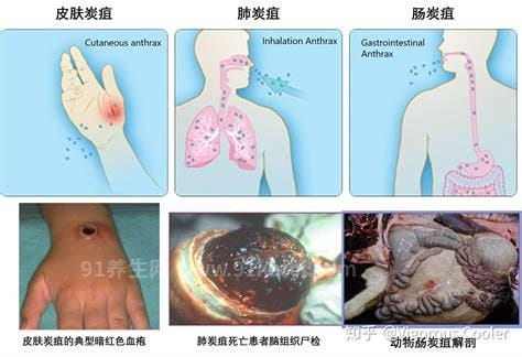 炭疽病有多可怕人感染炭疽病图片及