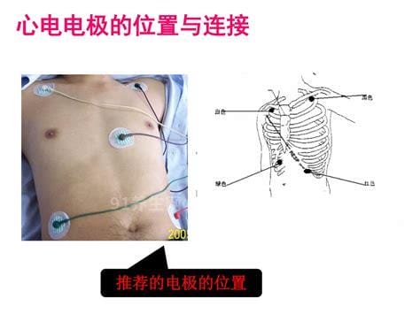 心电监护5个电极位置图及对应颜色，左腿(黑)/右腿(绿)优质