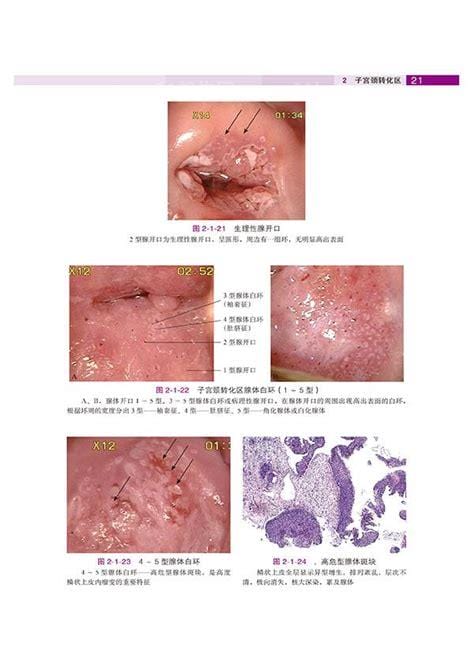 宫颈口有小硬疙瘩图片，很多是宫颈炎