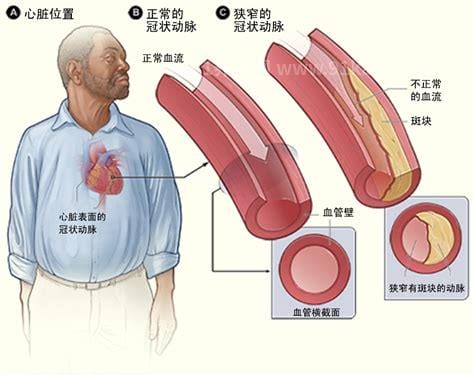 冠心病的症状及危害