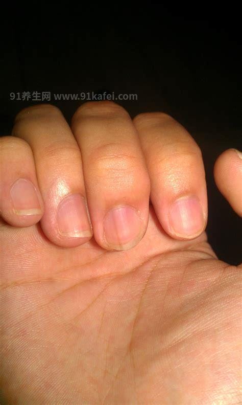 手指甲有黑点是什么病兆