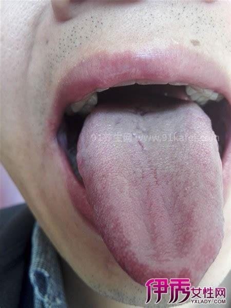 舌根淋巴滤泡增生症状