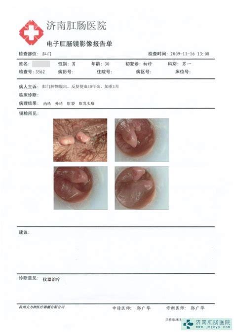 痔疮一般多久能好