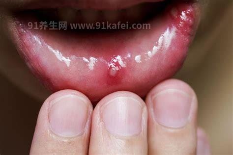 口腔溃疡癌变早期症状