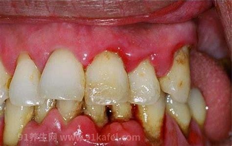 牙龈出血是缺什么维生素