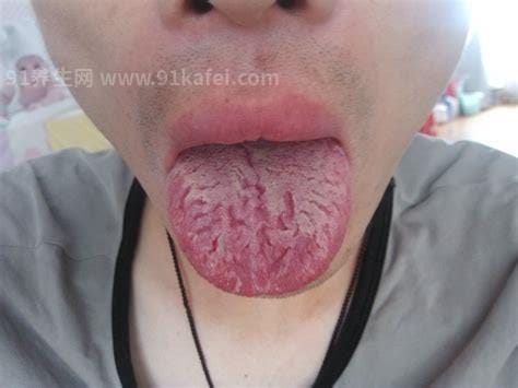 舌根溃疡是怎么回事