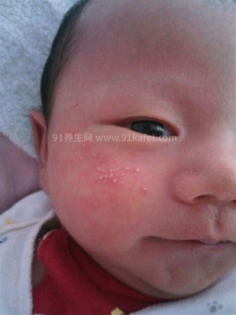 宝宝奶癣和湿疹的区别是什么啊