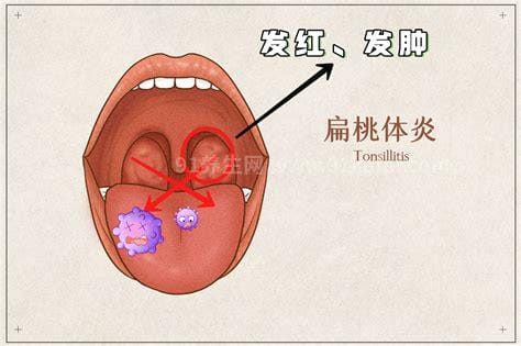 扁桃体发炎发烧可以吃鸡蛋吗