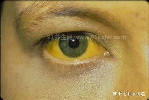 眼球发黄是什么原因