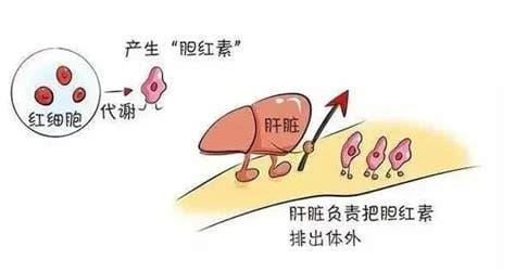 黄疸是什么原因引起的