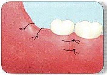 拔智齿需要缝针吗