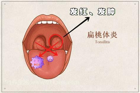 扁桃体发炎可以喝酒吗