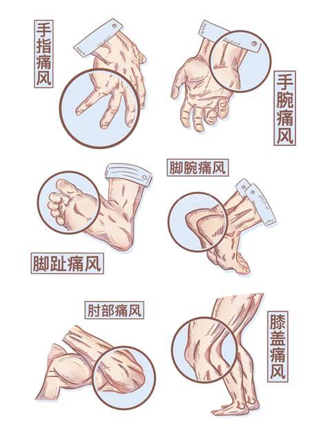 痛风在脚的哪个位置