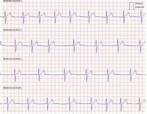 边缘心电图算不算大致正常