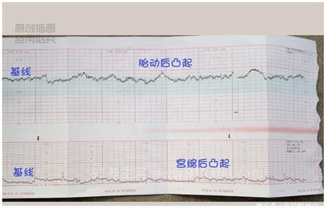 胎心监护图怎么看
