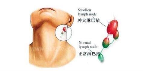 腋下淋巴癌早期症状图片 腋下淋巴