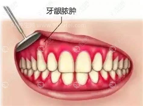 牙龈囊肿会自己消失吗