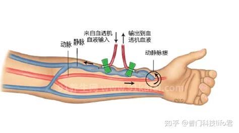 静脉导管是什么意思