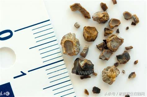 草酸钙结石怎么溶解