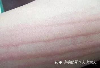 抓痕多久可以消除