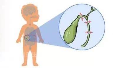胆道闭锁的孩子 7成最终需要肝移植