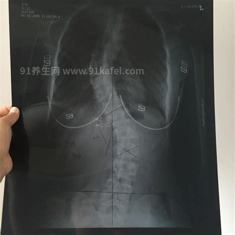 实拍：脊柱侧弯矫正手术全过程