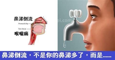 鼻涕倒流是哪种鼻炎