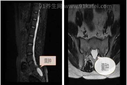 骶管囊肿能自愈吗