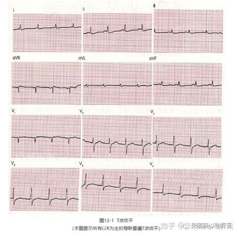 t波改变能恢复吗