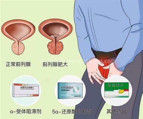 前列腺炎永远治不好了