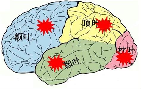 颞叶癫痫一般是什么样子的