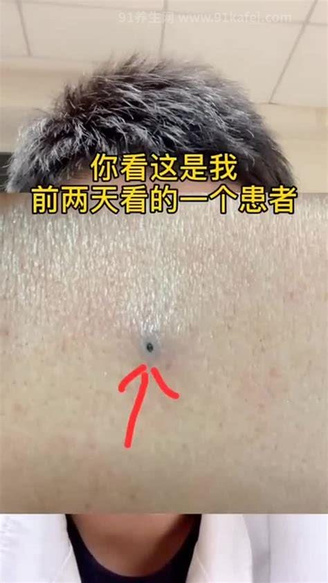 皮脂腺囊肿自己挤出来了,里面有根吗