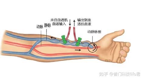 MS患者是什么意思