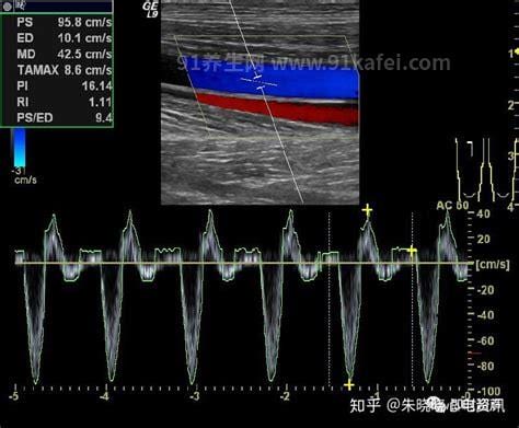 彩超血流频谱图怎么看