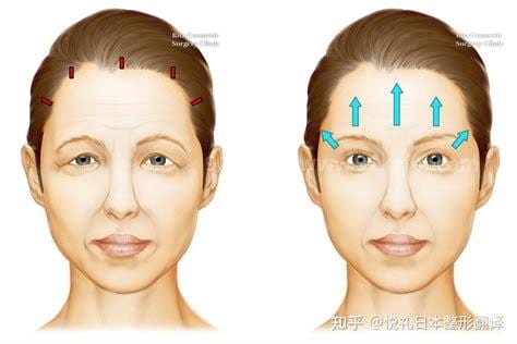 颞部提升除皱术的优势