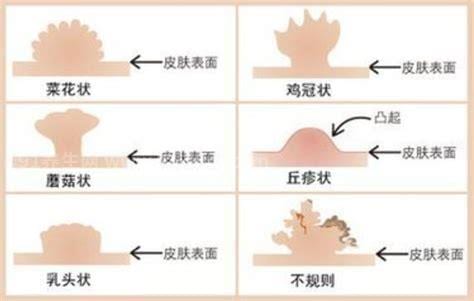 尖锐湿疣初期的小颗粒照片