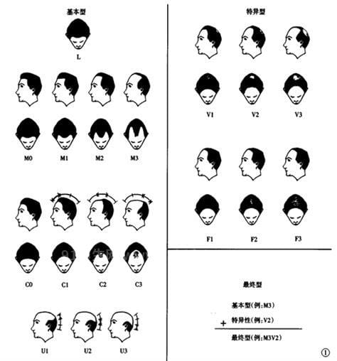 张建中教授：2.5亿人受脱发困扰，中国