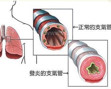 阿斯美急性支气管炎